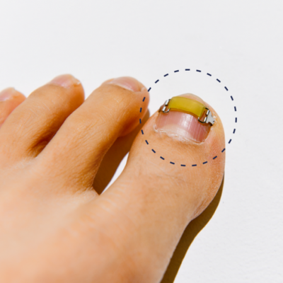 []170. 메디인랩 내성발톱 교정기 와이어 관리 도구 세트, 1세트